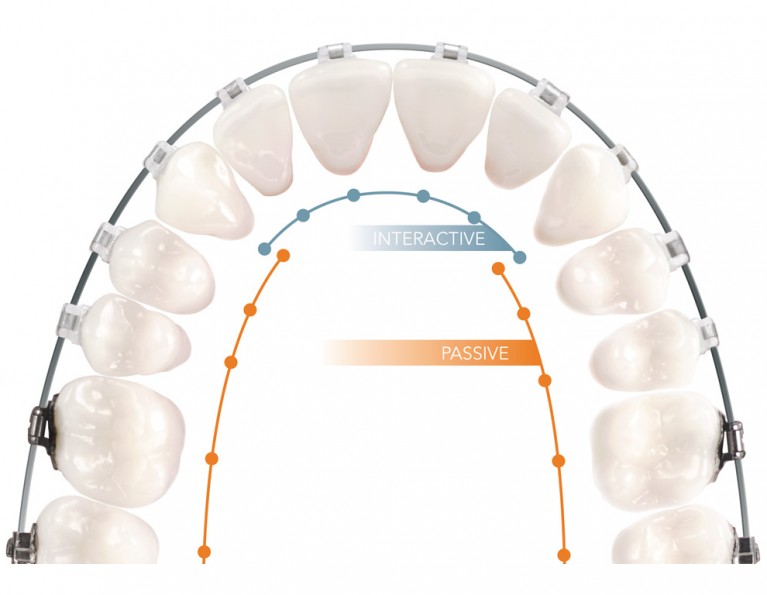 Self Ligating Brackets American Orthodontics