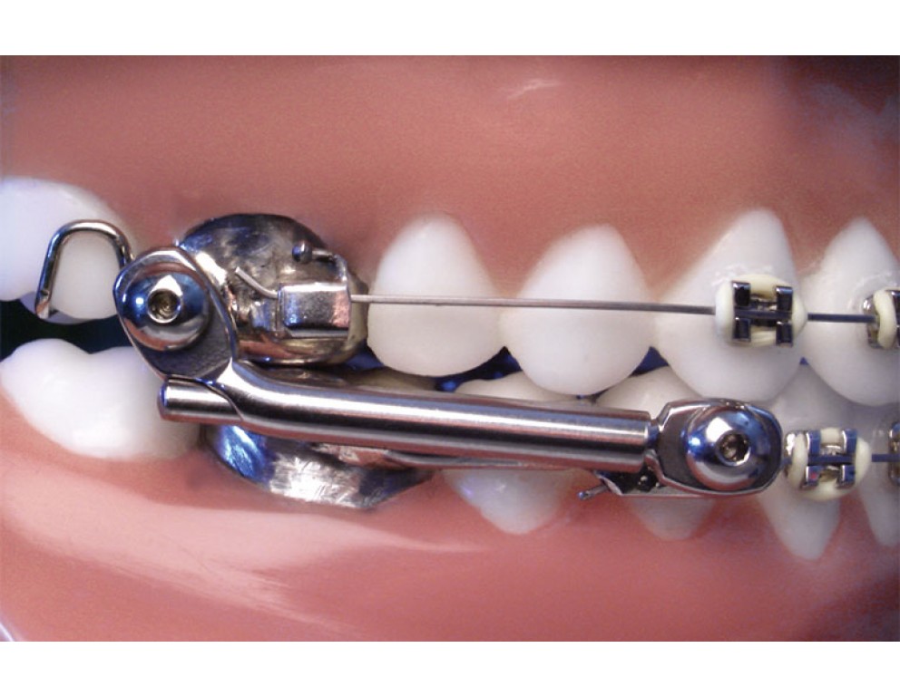 Herbst® Appliance American Orthodontics