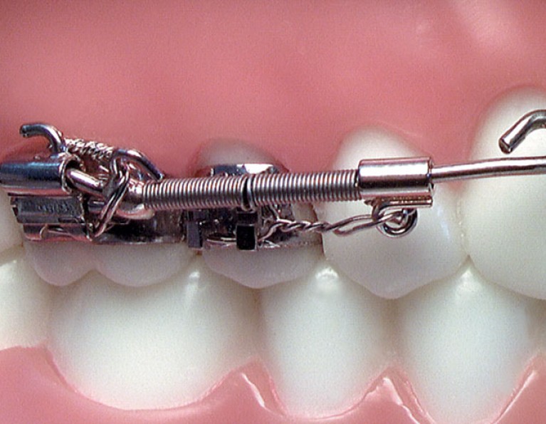 Fixed & Functional American Orthodontics