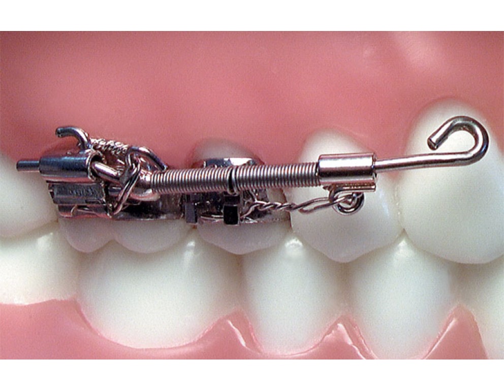 Jones Jig American Orthodontics