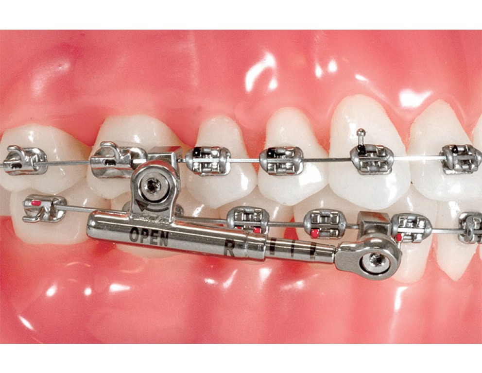 PowerScope™ 2 Class II Corrector | American Orthodontics