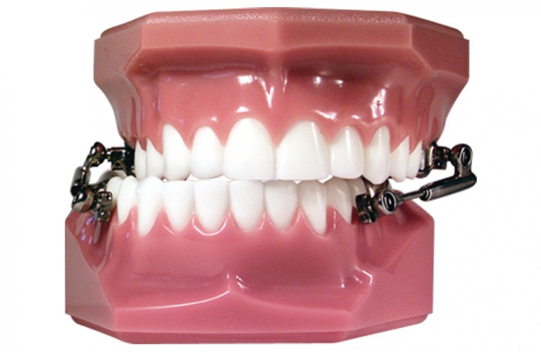 HTH Hanks Telescoping Herbst® American Orthodontics